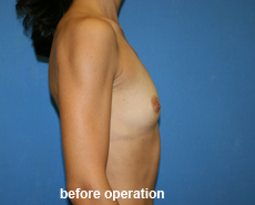 plastic-surgery-breast-augmentation
